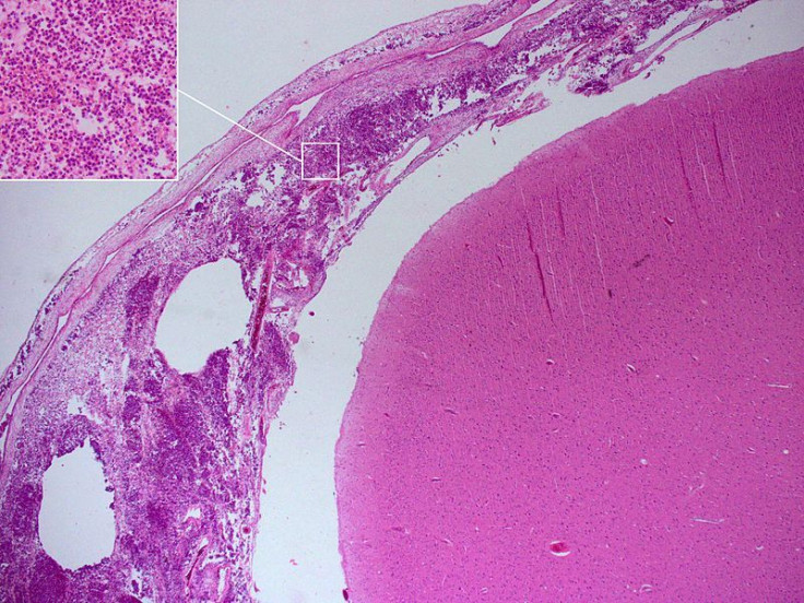 Bacterial meningitis