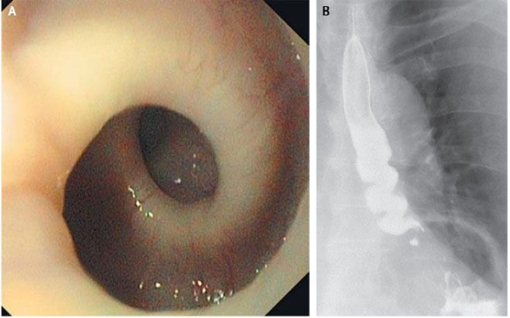 87-Year-Old Swiss Woman's Esophagus Twisted Itself Into a Corkscrew