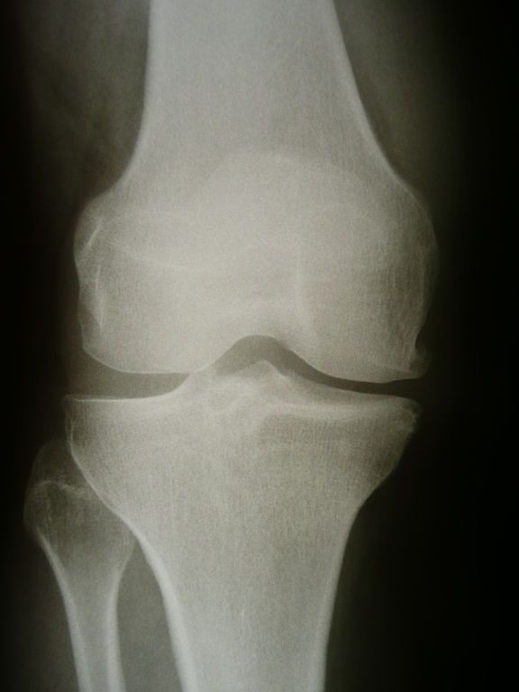 Removing Proteins in Fat Cells Might Be Key to Treating Rheumatoid Arthritis, Study Says