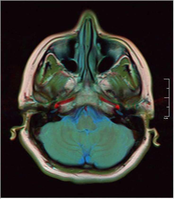 Brain MRI