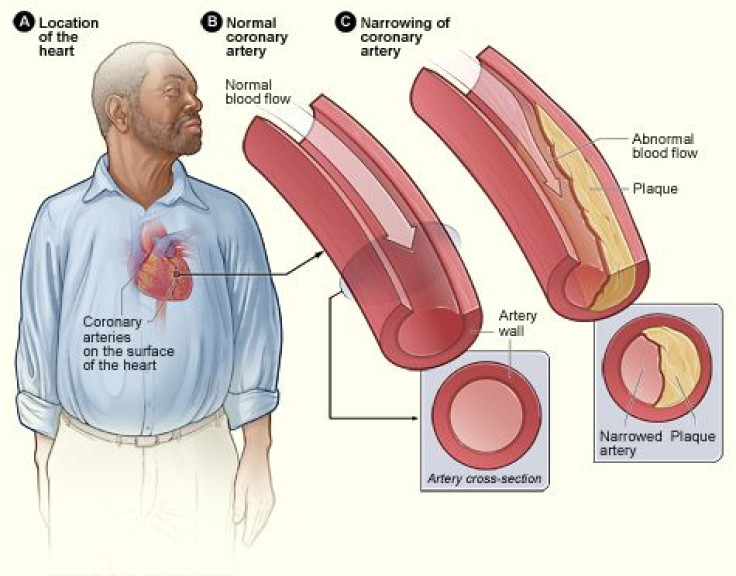 Atherosclerosis, cholesterol buildup in the blood vessels