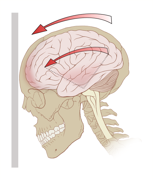 Brain Injury