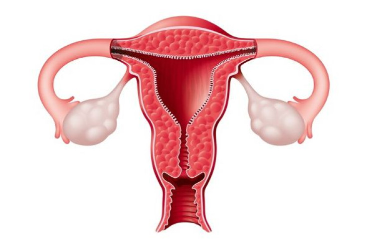 Slim Women Have a GreaterRisk of Developing Endometriosis Than Obese