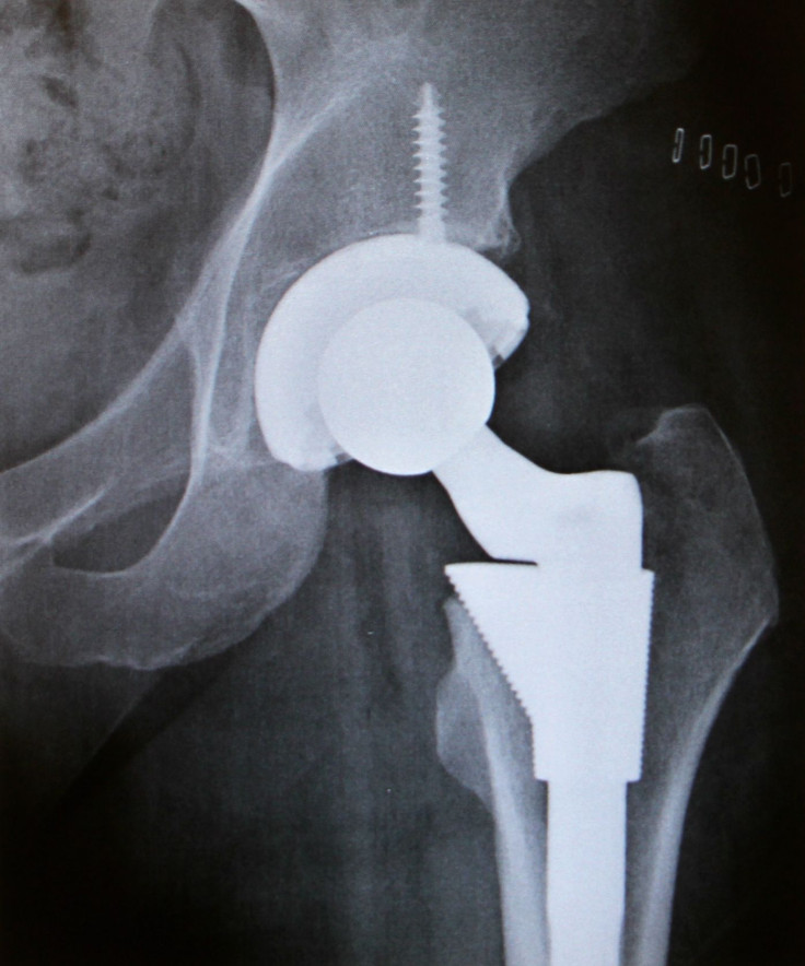 Hip replacement