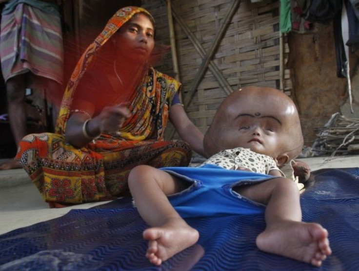 Hydrocephalus Shunt Surgery Treats Baby Roona Begum’s Swollen Head