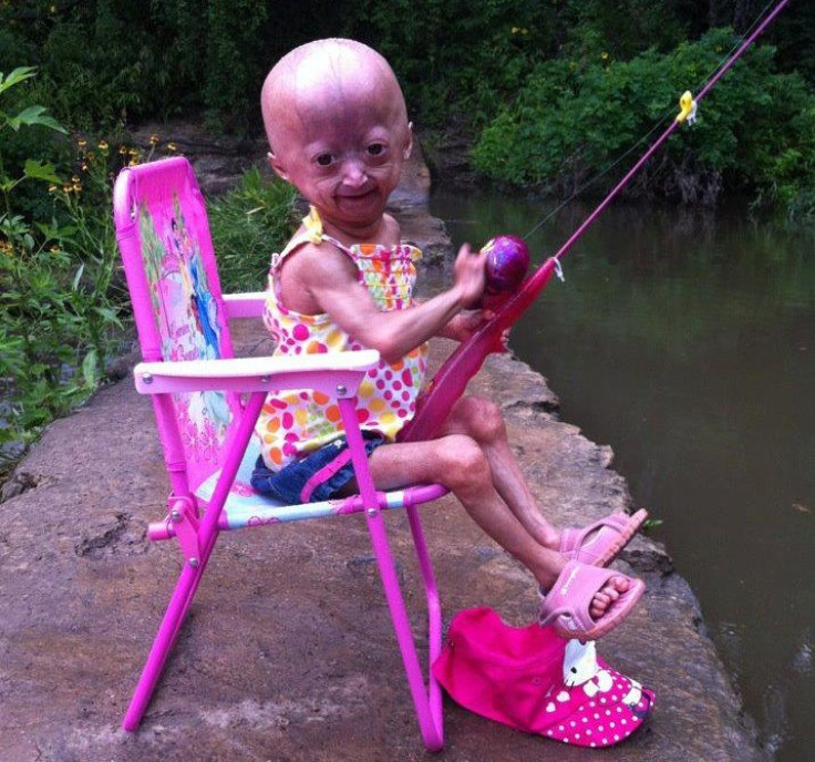 Adalia Rose - Accelerated Aging Child - Progeria Treatment In Development