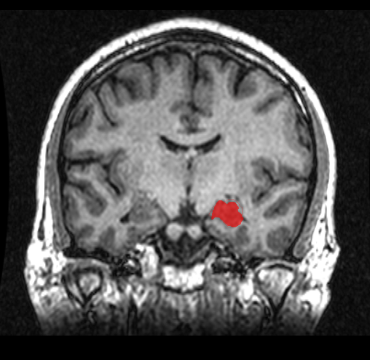 hippocampus MRI