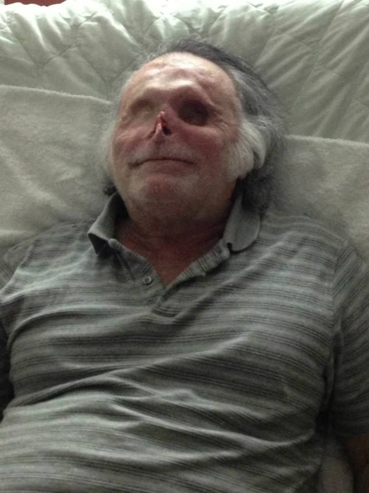 Ronald Poppo Miami Zombie Victim Face Recovery