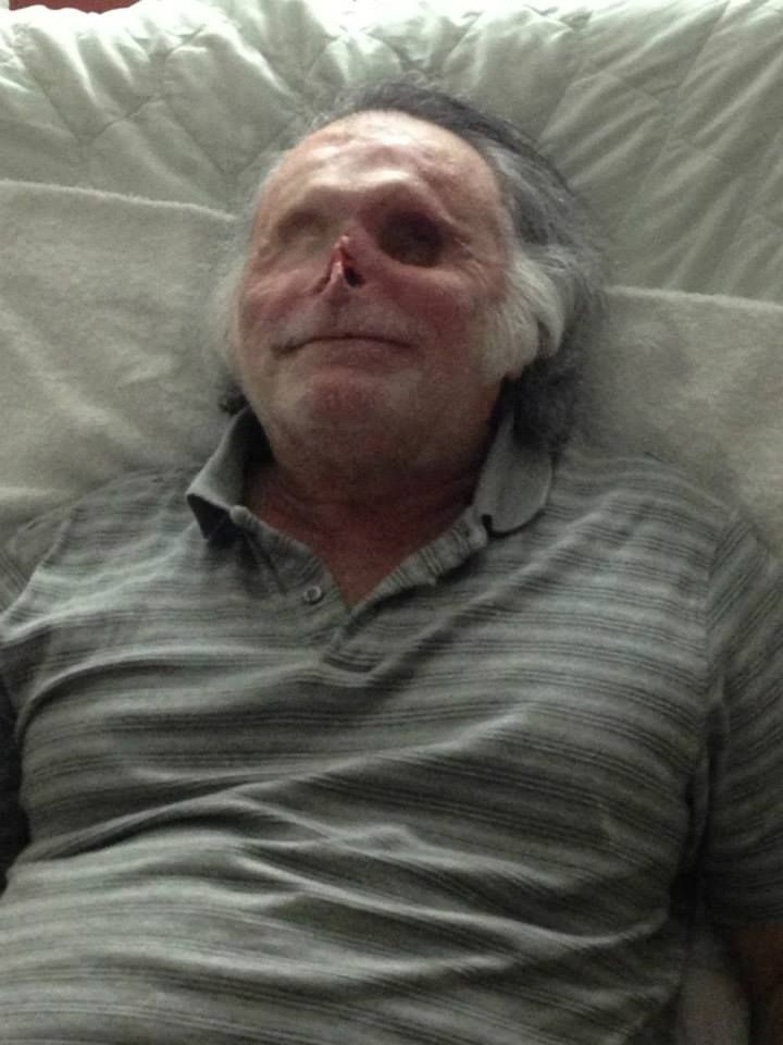 ‘Miami Zombie’ Victim Ronald Poppo Happily Recovering After Skin Grafts