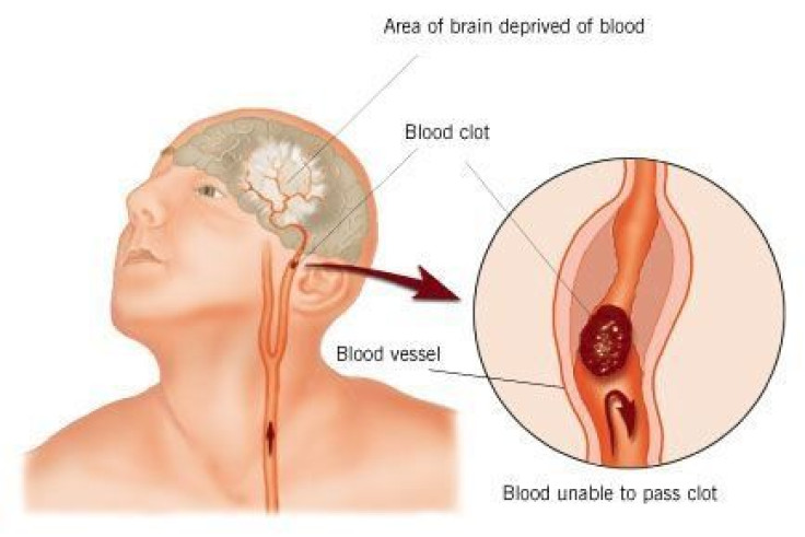 Stroke Treatment Costs To Double By 2030