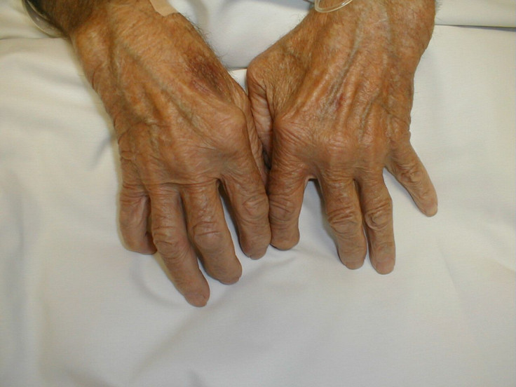 Marker for severe rheumatoid arthritis found