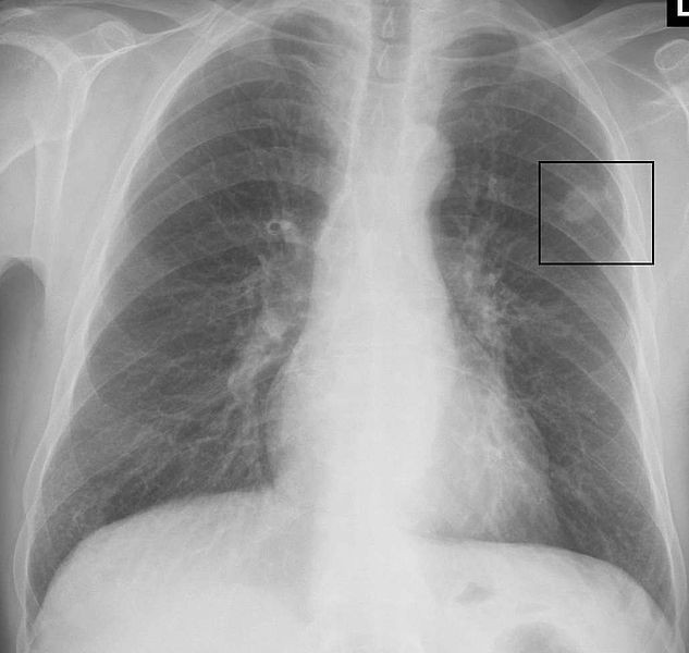 lung cancer