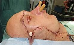 Polish Face Transplant