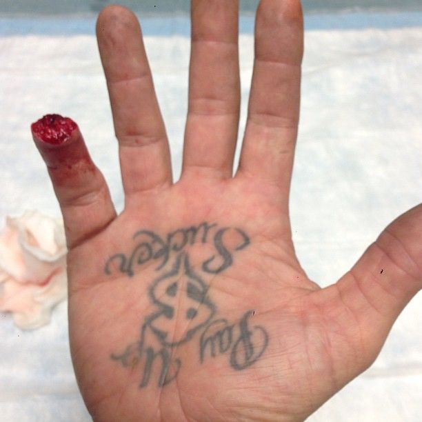 Jesse James Chops Finger in Accident