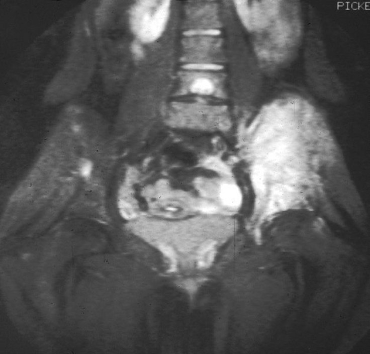 Ewing's Sarcoma