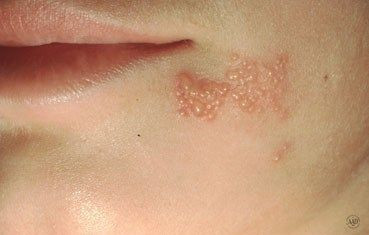 Oral Herpes