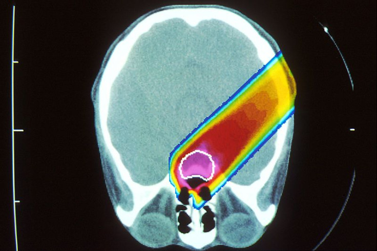 Proton Beam Therapy: Is it Necessary for Treating Cancer?