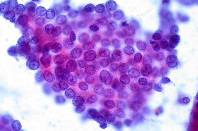Papillary Thyroid Carcinoma, FNA, Rapid Pap Stain