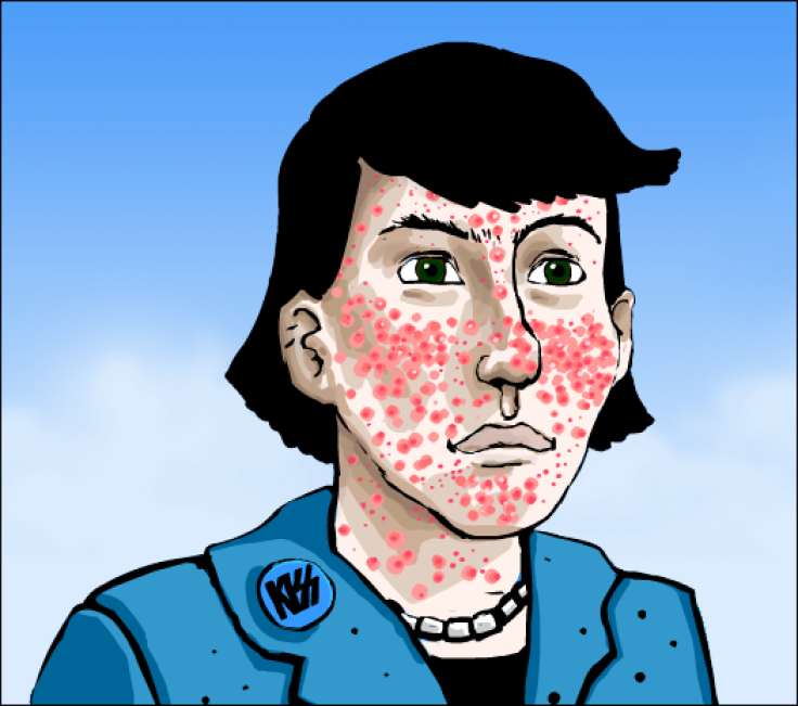 Cartoon of severe acne.