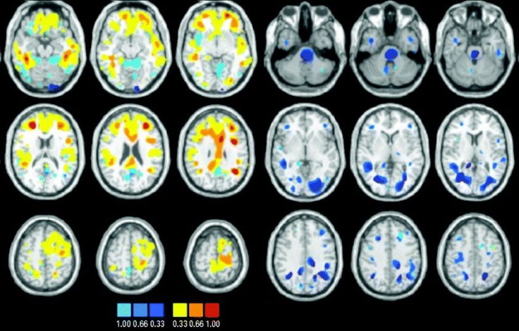 Bipolar Disorder Diagnosis May Soon Include MRI Test