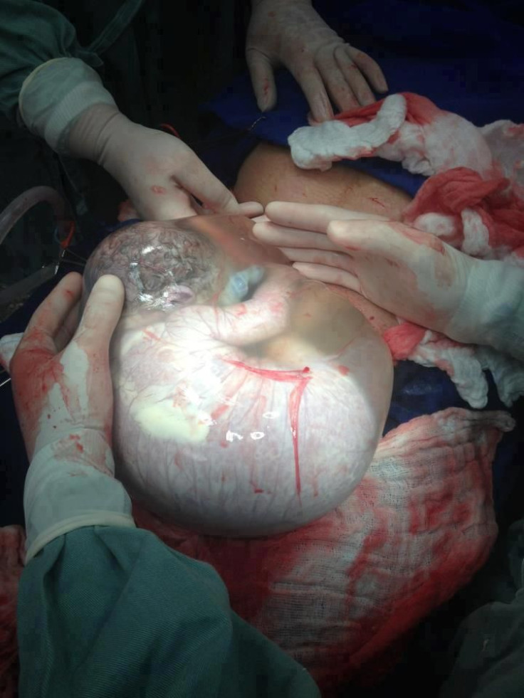 Newborn Baby Delivered En Caul Floating in Intact Amniotic Sac by Greek Doctor