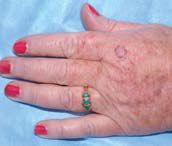 Actinic keratoses