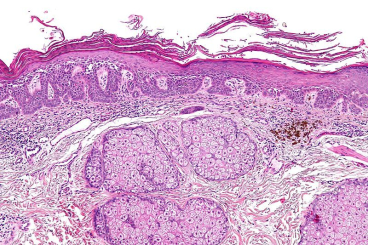 Actinic keratosis