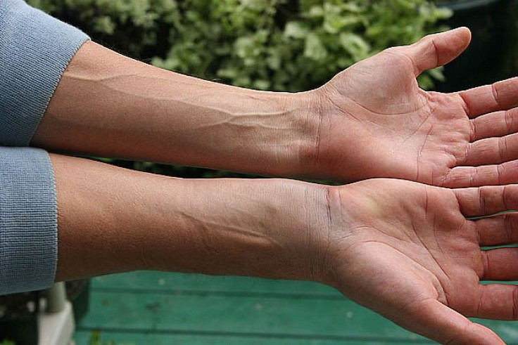 Wrist-based coronary angioplasty has fewer complications relative to accessing blockages in the heart via thigh arteries.
