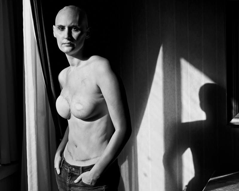 Facebook Mastectomy Photos of Breast Cancer Survivors