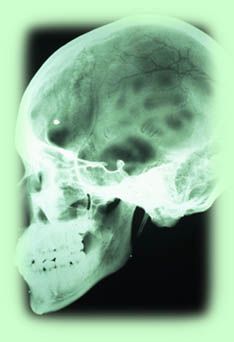 Pentagon Establishes Brain Tissue Collection For Study Of Traumatic Brain Injury