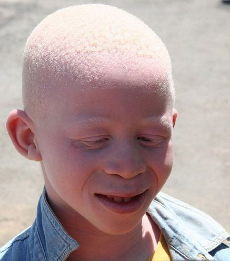 Albinos Abused In Tanzania