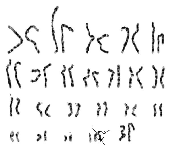 Emanuel Syndrome, Rare Chromosomal Disorder