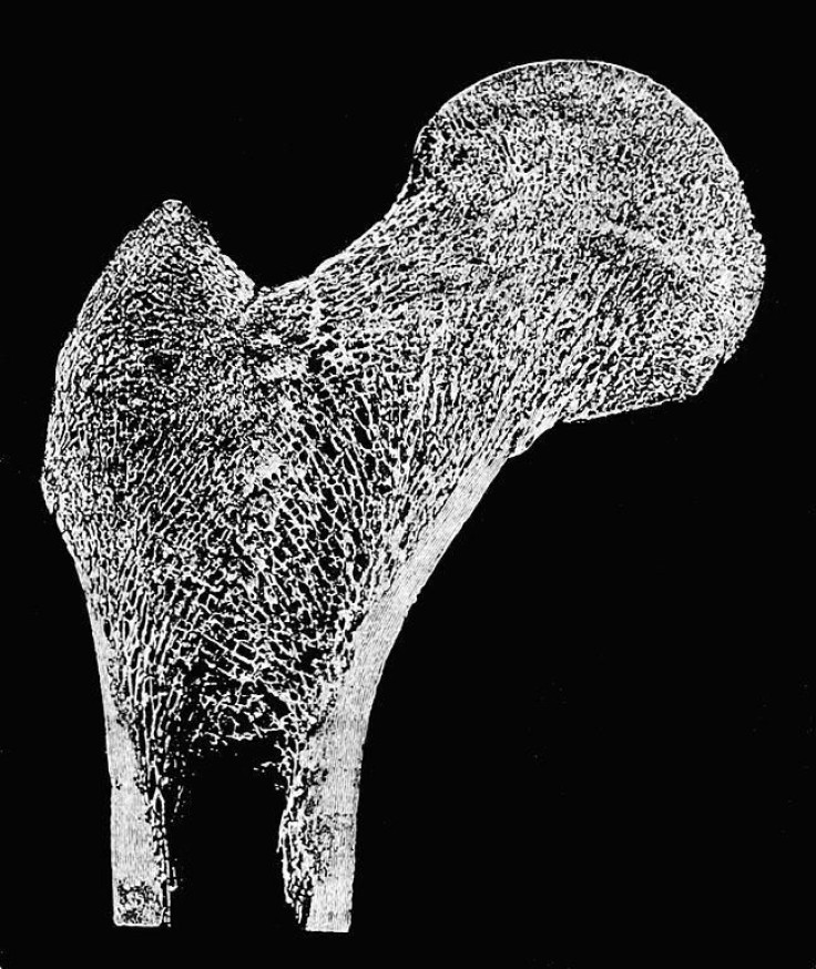 3-D printing of artificial bone