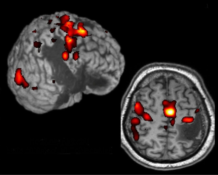 Stroke Effects on the Brain