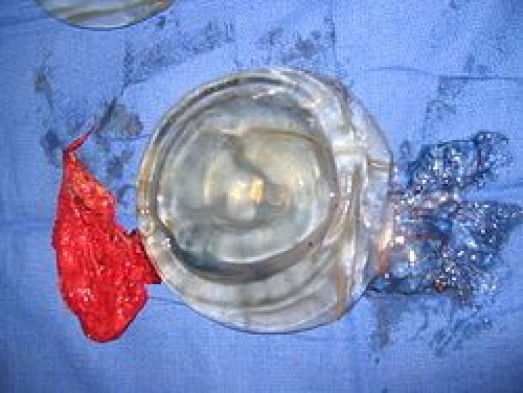 Breast Implant