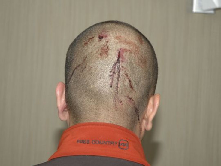 George Zimmerman's Injuries