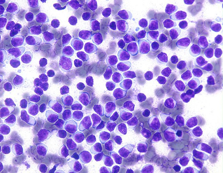 CLL lymphoma