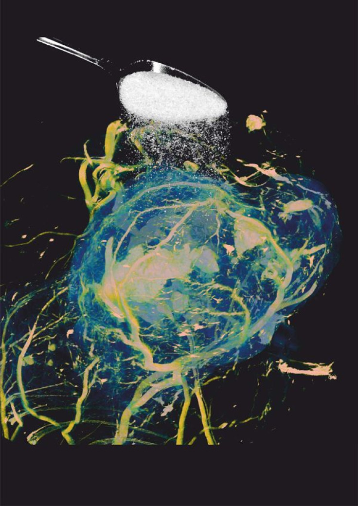 University College London scientists have developed a new technique for detecting the uptake of sugar in tumors, using magnetic resonance imaging.