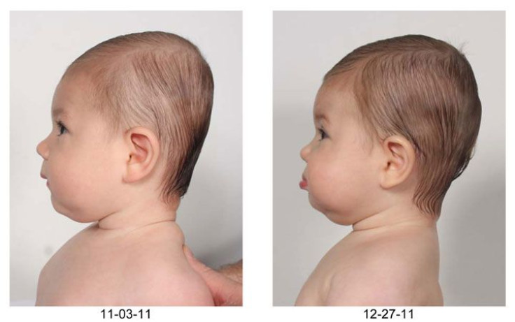 Plagiocephaly