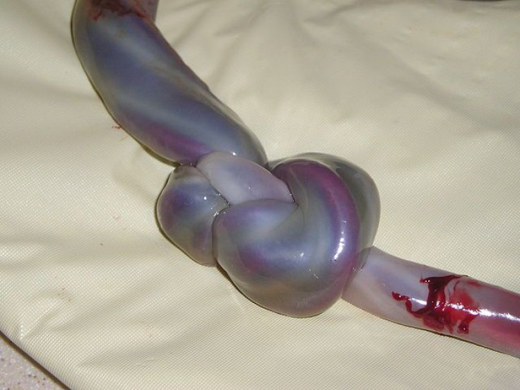 Umbilical Cord