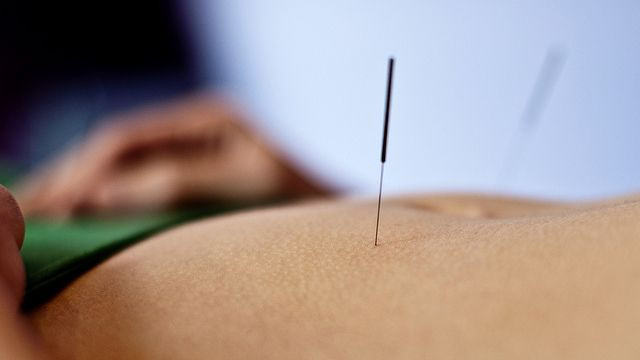 Acupuncture