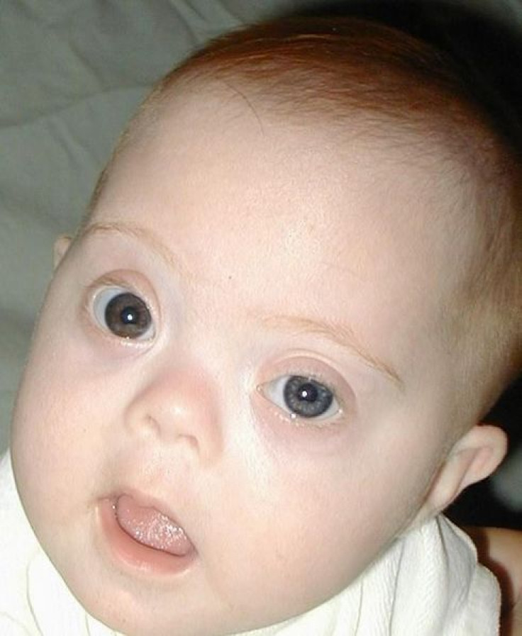 Baby With Down Syndrome