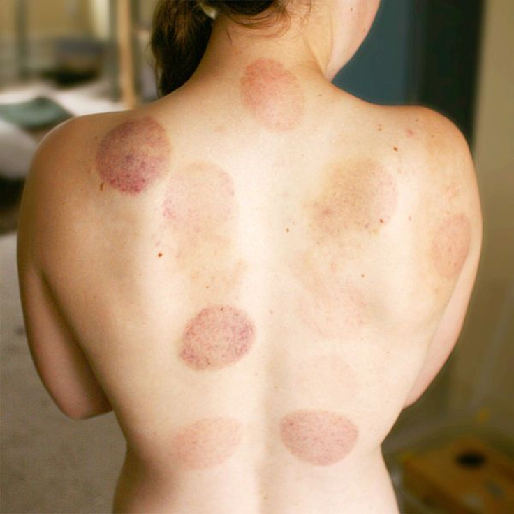 Woman with cupping bruises