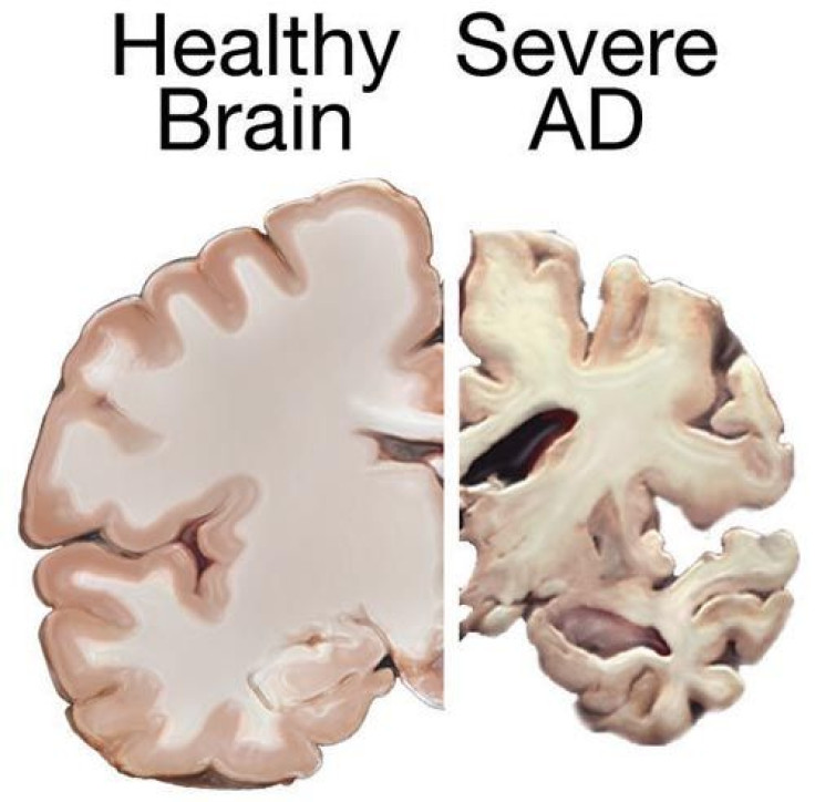 Brain on Alzheimer's