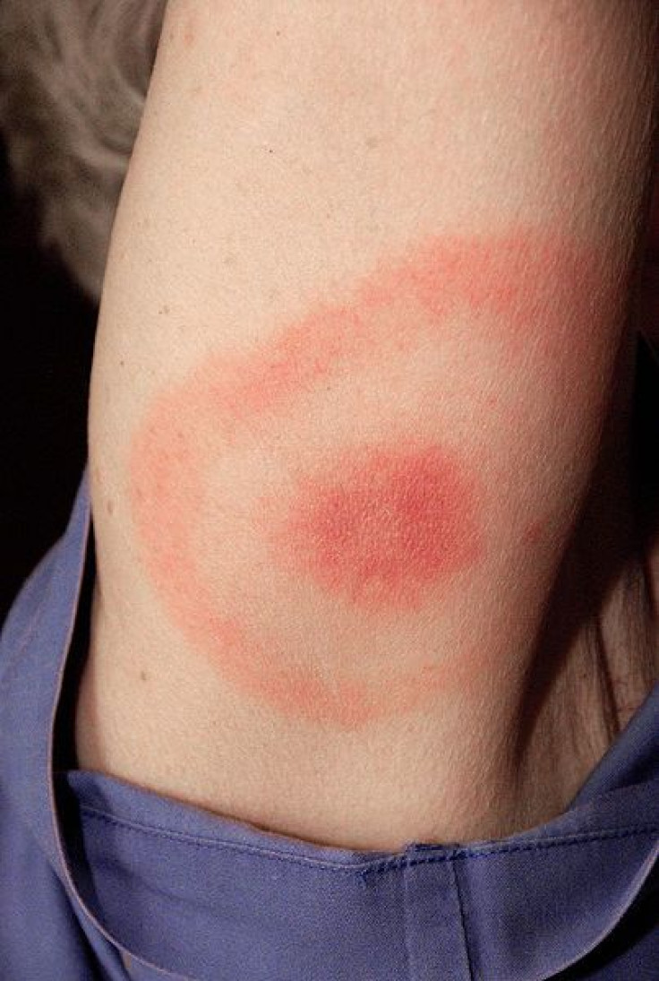 erythema migrans 