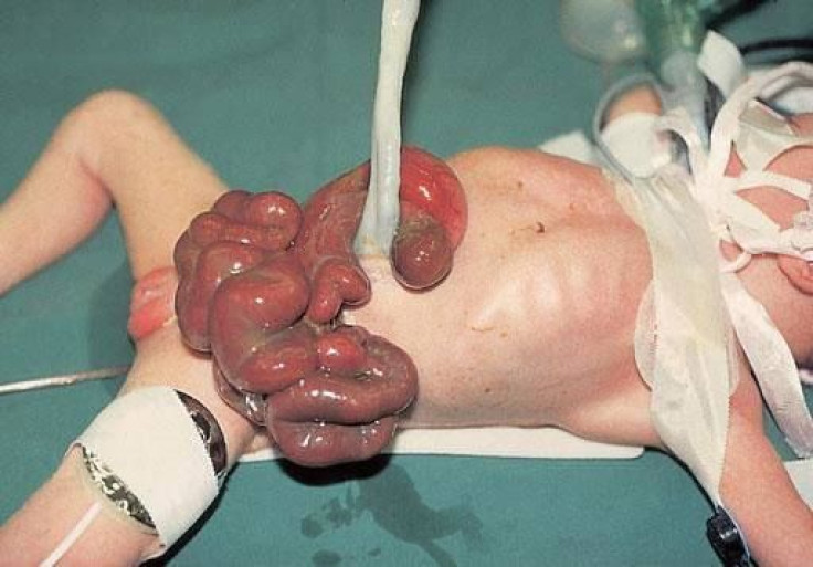 gastroschisis