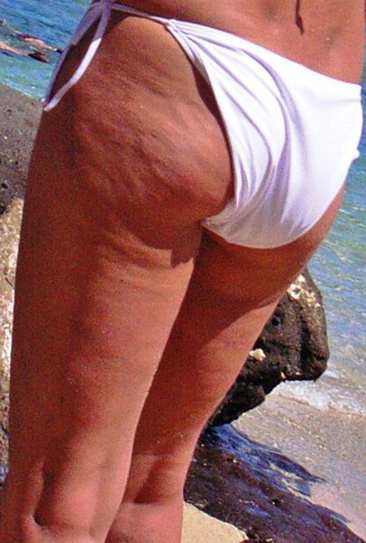 Cellulite on a woman