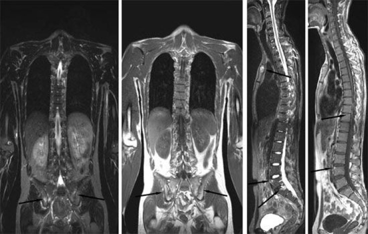 Axial Spondylarthritis