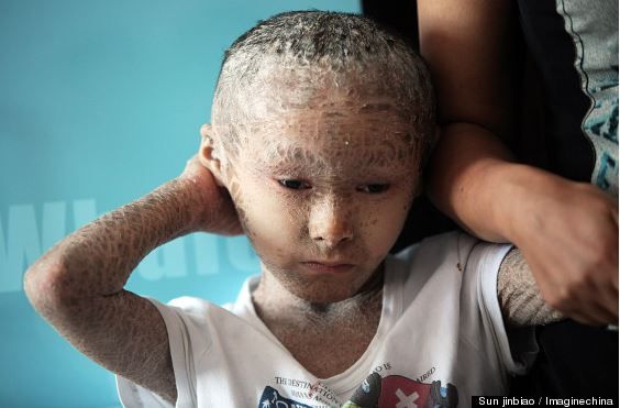 8-Year-Old 'Fish Boy,' Pan Xianhang, Suffers From Rare Inherited