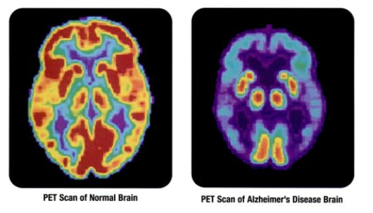 PET scan